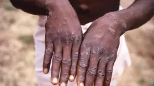 image for Nigerian Govt Issues Fresh Alert on Dengue, Cholera, Mpox Outbreaks